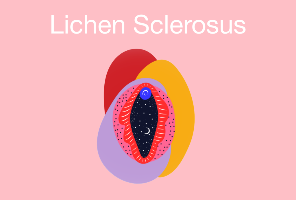 Lichen Sclerosus